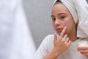 How To Remove Pimple Marks: A Complete Guide